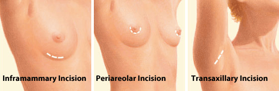 Breast Augmentation Incision Locations