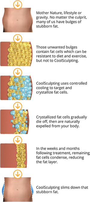 The CoolSculpting Process