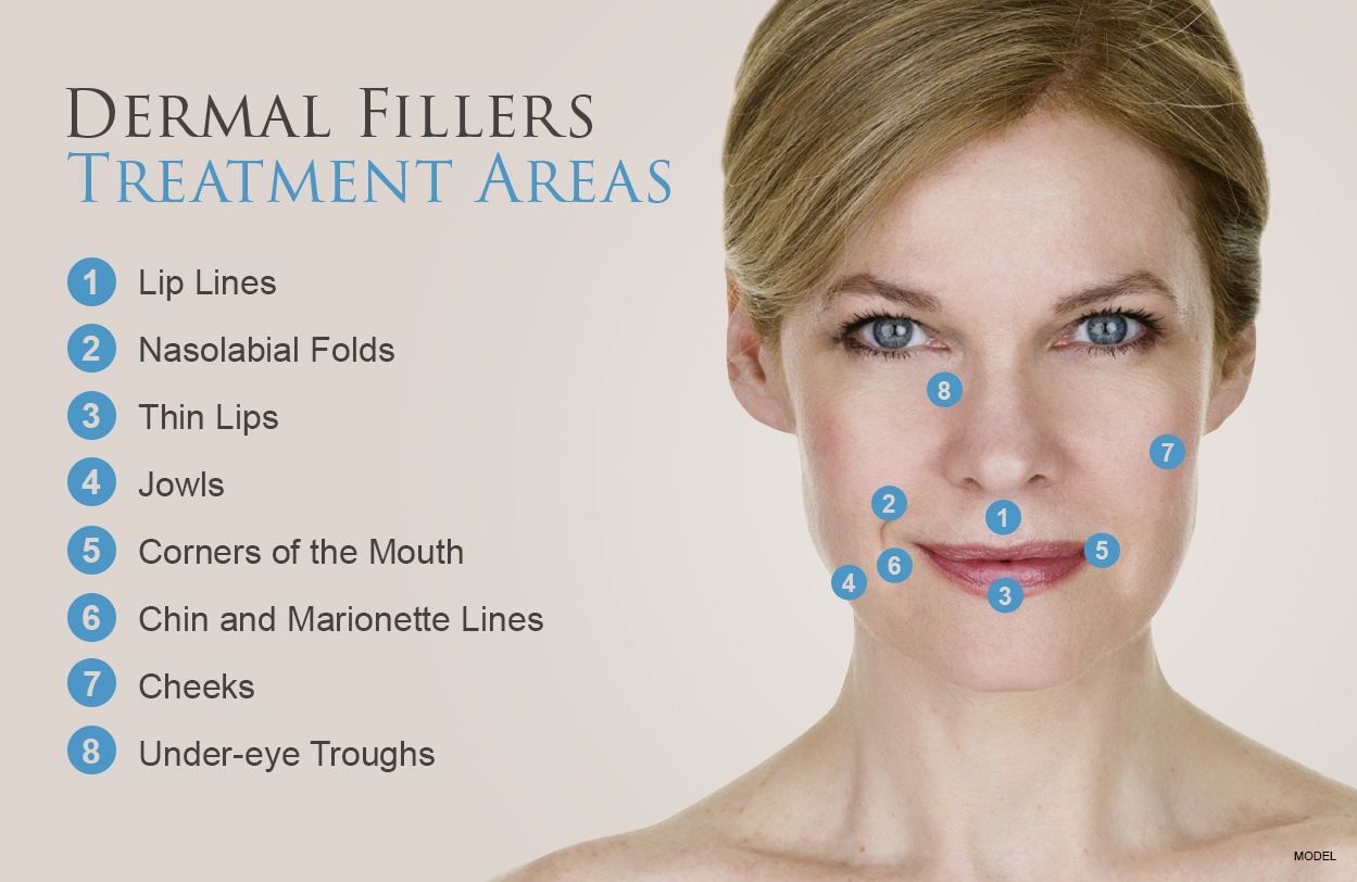 Dermal Fillers Treatment Diagram