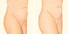 Tummy Tuck Drawing