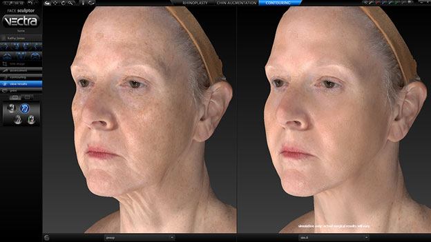 VECTRA® 3-D Imaging for Cosmetic Plastic Surgery on Staten Island