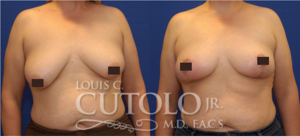 Woman before and after a breast lift procedure with Dr. Cutolo.