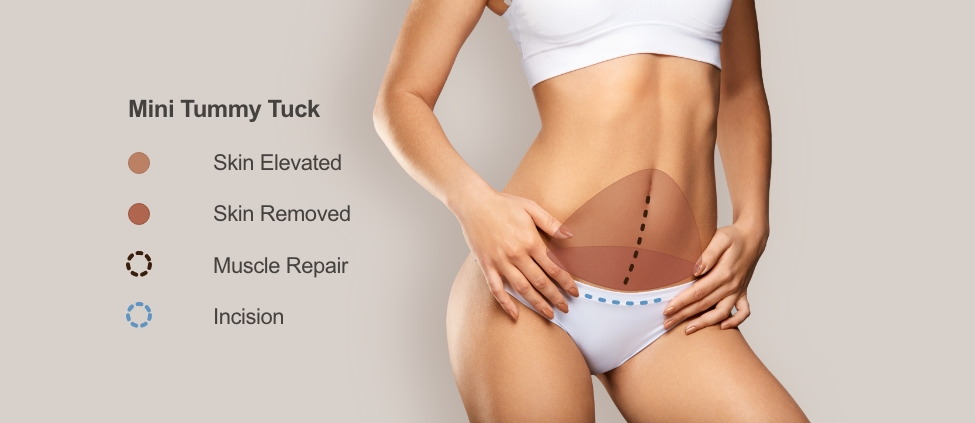 Tummy Tuck (Abdominoplasty) for Staten Island & Brooklyn