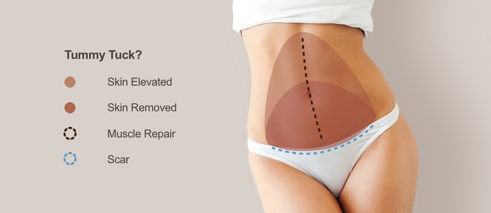 Tummy Tuck (Abdominoplasty) for Staten Island & Brooklyn