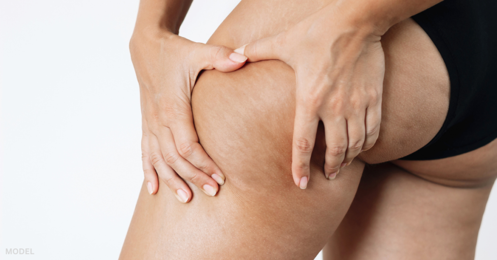 Woman with cellulite (model) holding her leg with her hands.
